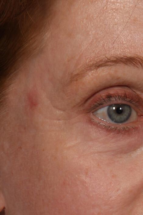 Wrinkle Reduction Gallery Before & After Image