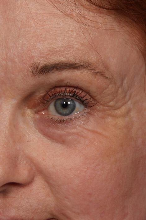 Wrinkle Reduction Gallery Before & After Image