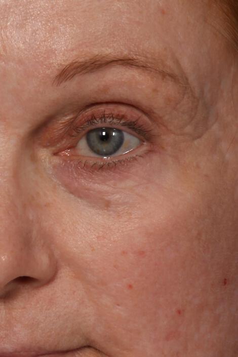 Wrinkle Reduction Gallery Before & After Image