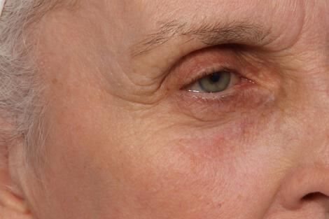 Wrinkle Reduction Gallery Before & After Image