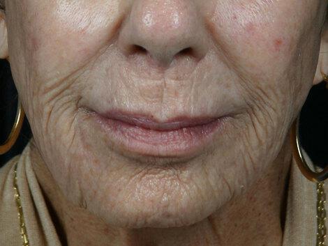 Wrinkle Reduction Gallery Before & After Image