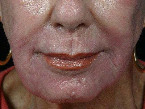 Wrinkle Reduction Gallery Before & After Image