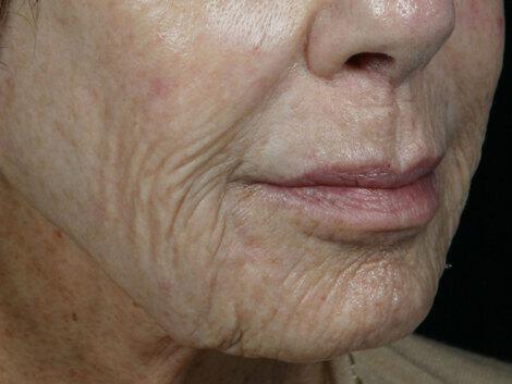 Wrinkle Reduction Gallery Before & After Image