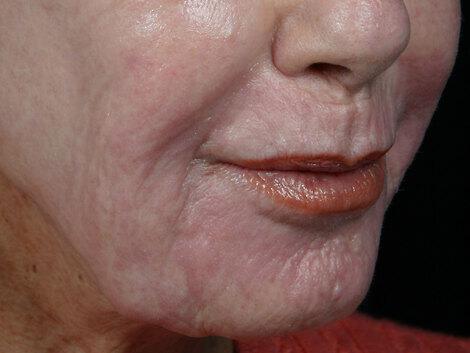 Wrinkle Reduction Gallery Before & After Image