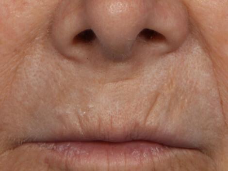 Wrinkle Reduction Gallery Before & After Image