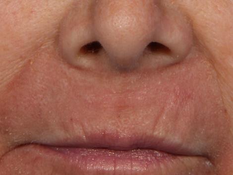 Wrinkle Reduction Gallery Before & After Image