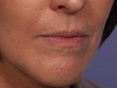 Wrinkle Reduction Gallery Before & After Image