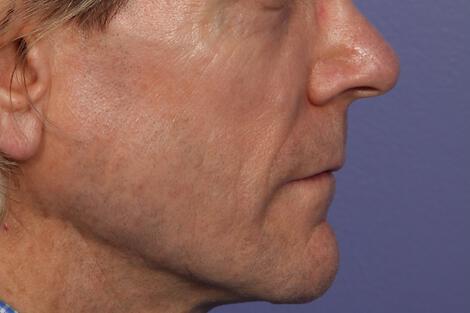 Wrinkle Reduction Gallery Before & After Image