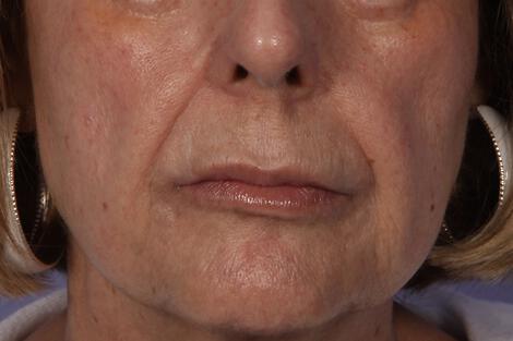 Wrinkle Reduction Gallery Before & After Image