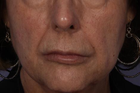 Wrinkle Reduction Gallery Before & After Image