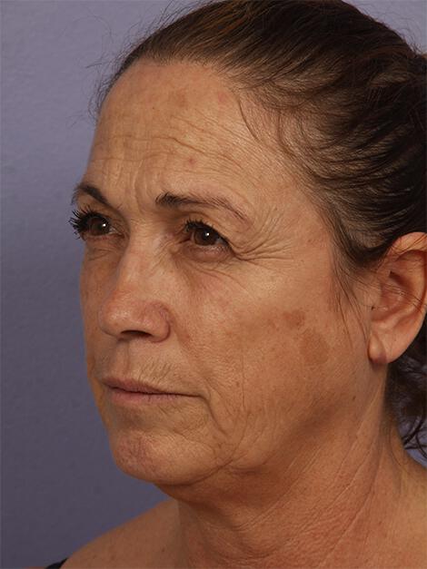 Chemical Peels Gallery Before & After Image