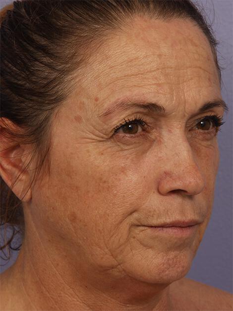 Chemical Peels Gallery Before & After Image
