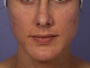 Chemical Peels Gallery Before & After Image