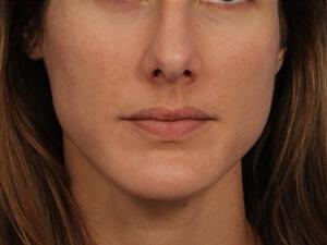 Chemical Peels Gallery Before & After Image