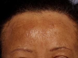 Chemical Peels Gallery Before & After Image