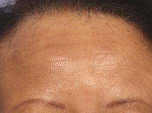 Chemical Peels Gallery Before & After Image