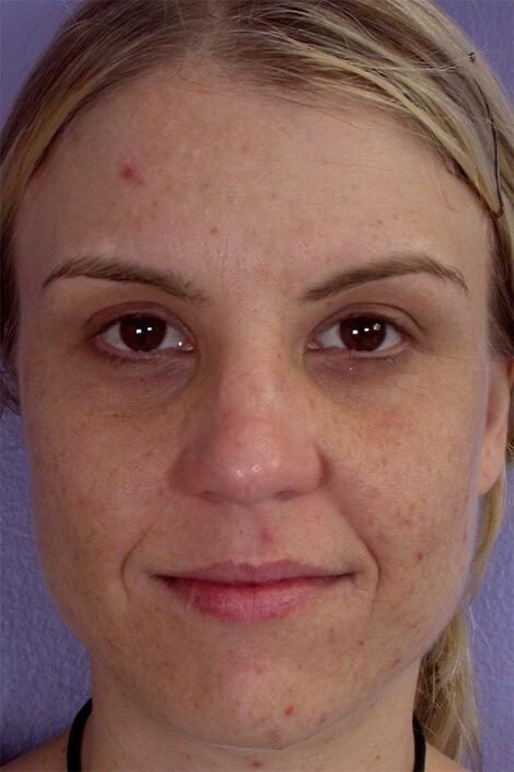 Chemical Peels Gallery Before & After Image