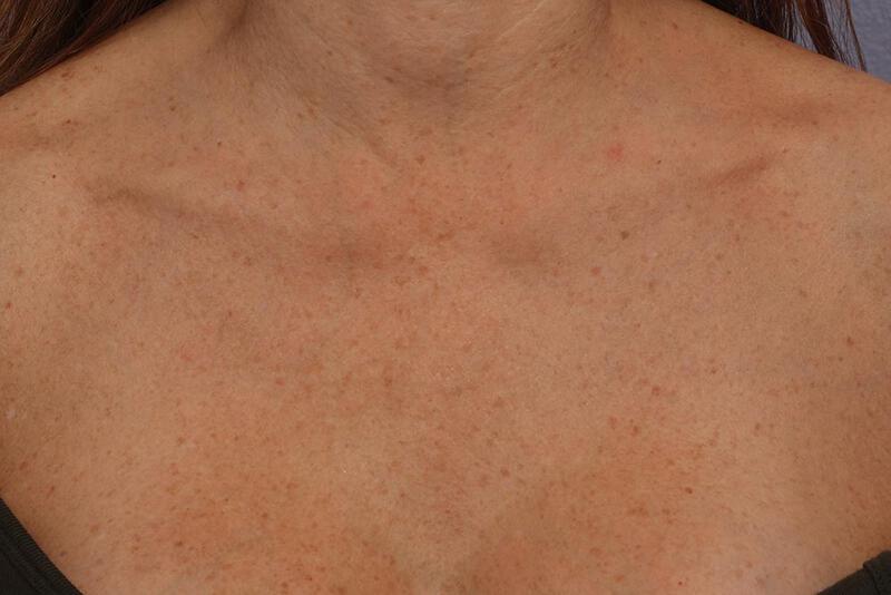 Laser Skin Resurfacing Gallery Before & After Image