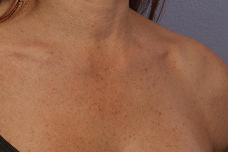 Laser Skin Resurfacing Gallery Before & After Image