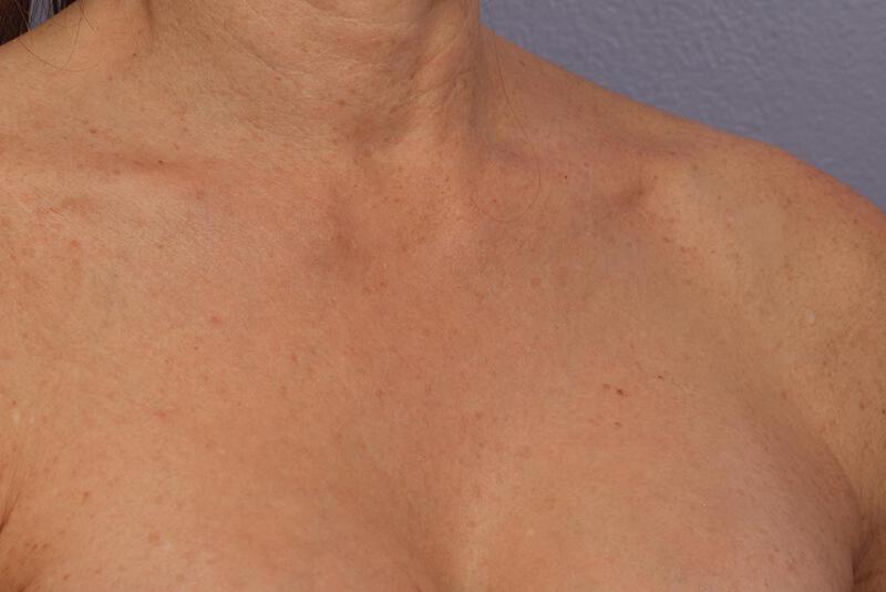 Laser Skin Resurfacing Gallery Before & After Image