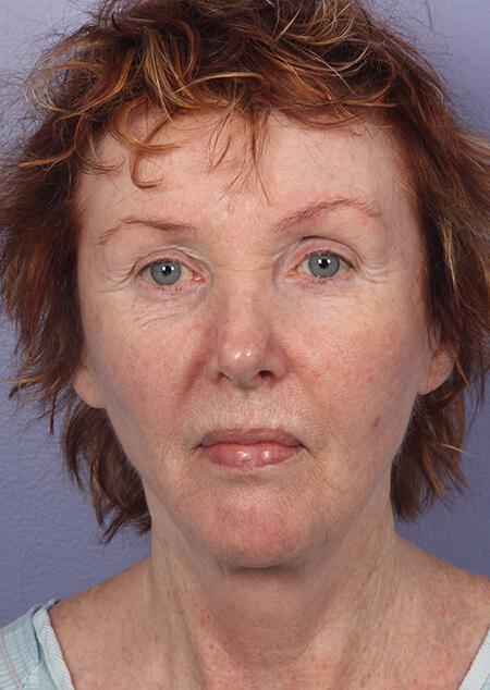 Laser Skin Resurfacing Gallery Before & After Image