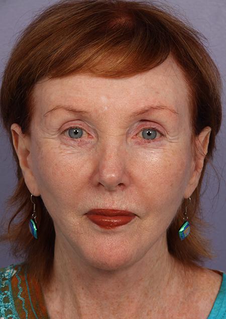 Laser Skin Resurfacing Gallery Before & After Image