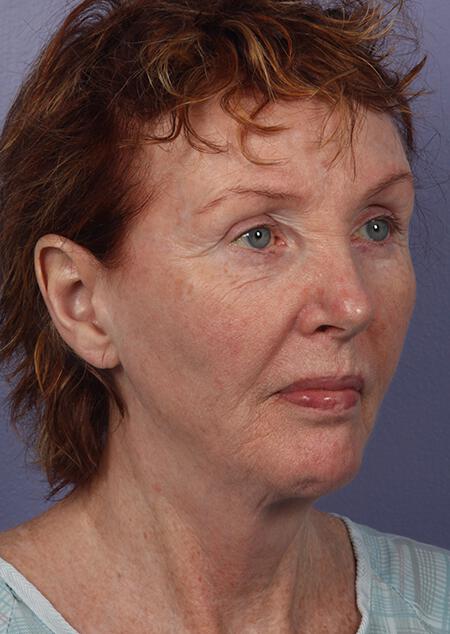 Laser Skin Resurfacing Gallery Before & After Image