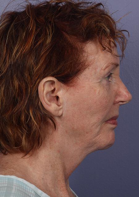 Laser Skin Resurfacing Gallery Before & After Image