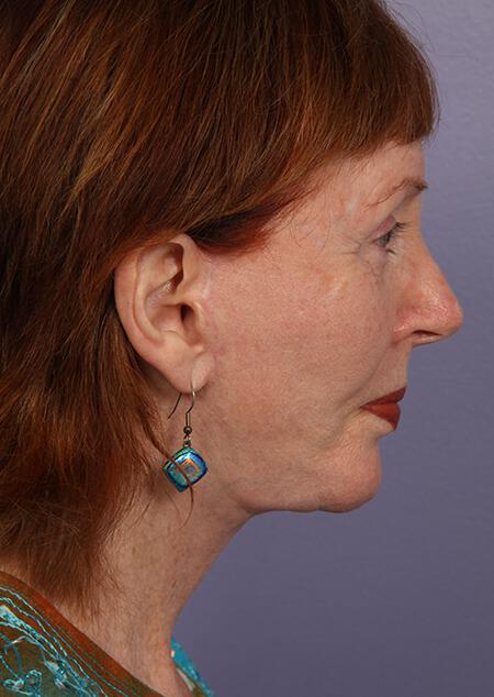 Laser Skin Resurfacing Gallery Before & After Image