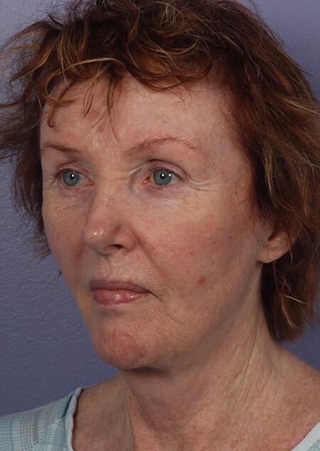 Laser Skin Resurfacing Gallery Before & After Image