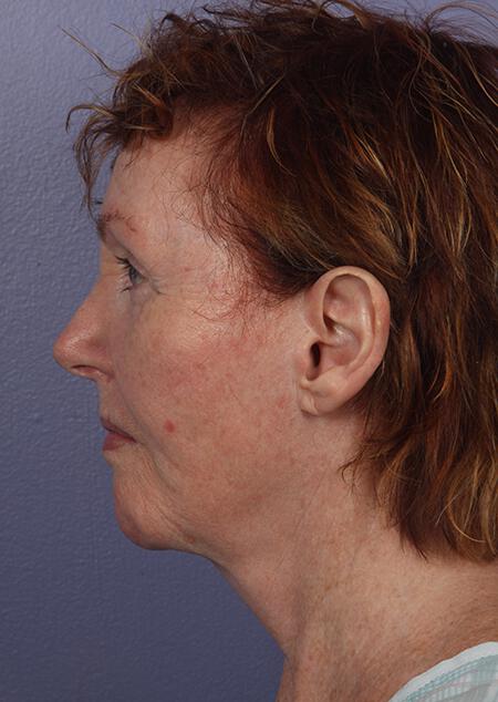 Laser Skin Resurfacing Gallery Before & After Image