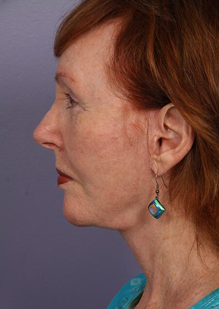 Laser Skin Resurfacing Gallery Before & After Image