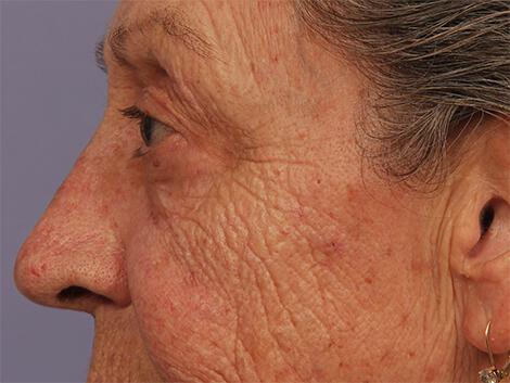 Laser Skin Resurfacing Gallery Before & After Image