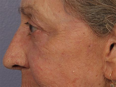 Laser Skin Resurfacing Gallery Before & After Image