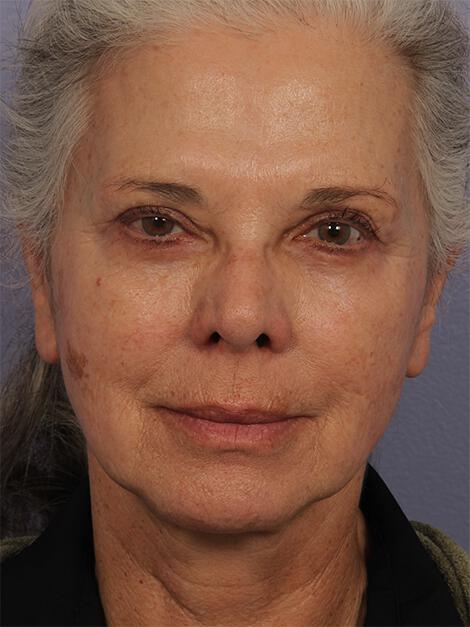 Laser Skin Resurfacing Gallery Before & After Image