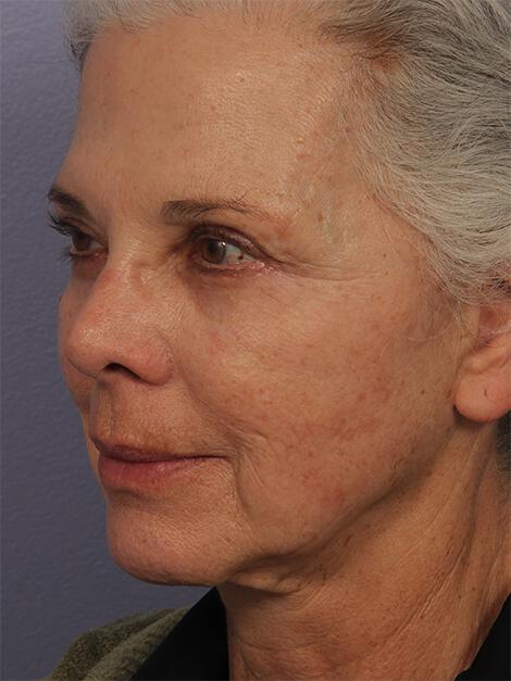 Laser Skin Resurfacing Gallery Before & After Image