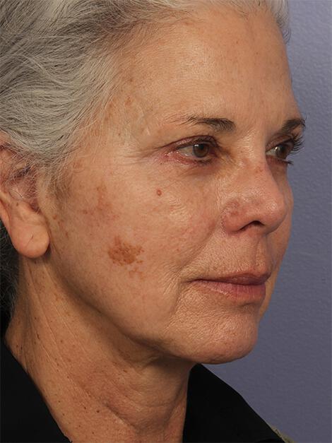 Laser Skin Resurfacing Gallery Before & After Image