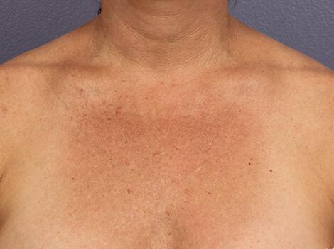 Laser Skin Resurfacing Gallery Before & After Image