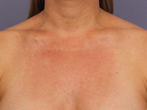 Laser Skin Resurfacing Gallery Before & After Image