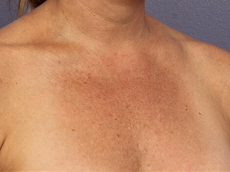 Laser Skin Resurfacing Gallery Before & After Image