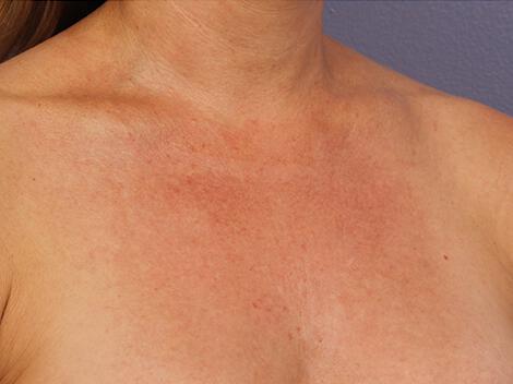 Laser Skin Resurfacing Gallery Before & After Image