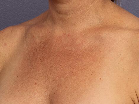 Laser Skin Resurfacing Gallery Before & After Image