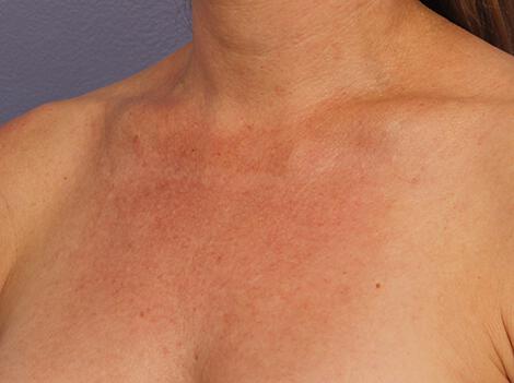 Laser Skin Resurfacing Gallery Before & After Image