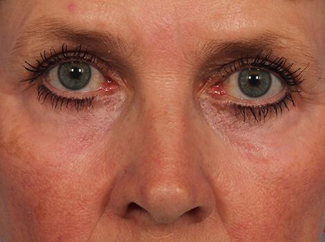 Laser Skin Resurfacing Gallery Before & After Image