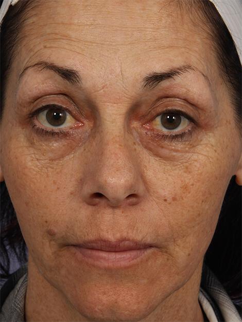 Laser Skin Resurfacing Gallery Before & After Image