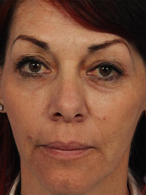 Laser Skin Resurfacing Gallery Before & After Image