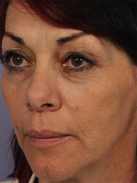 Laser Skin Resurfacing Gallery Before & After Image