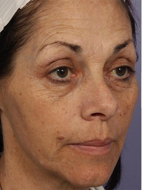 Laser Skin Resurfacing Gallery Before & After Image