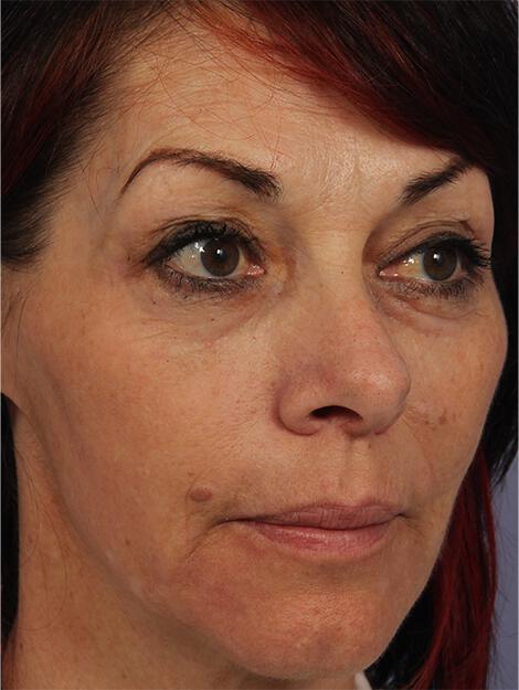 Laser Skin Resurfacing Gallery Before & After Image