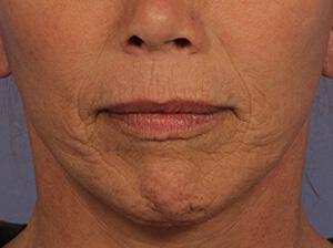 Laser Skin Resurfacing Gallery Before & After Image